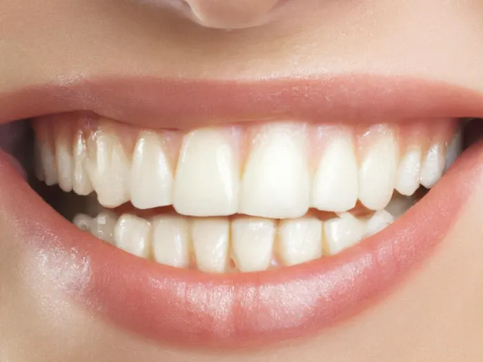 Ilustração de clareamento dental